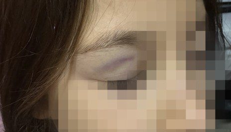 bimba picchiata scuola 8 anni coetanee borrelli denuncia