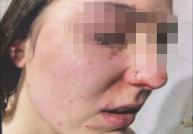 agguato 12enne marano amiche pestaggio