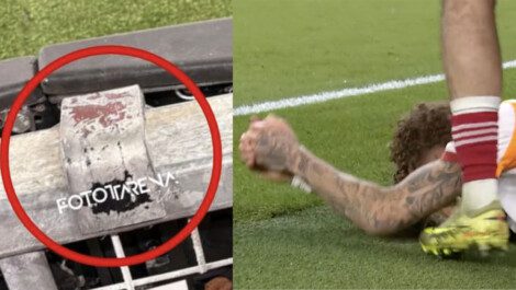 Champions Lang dito amputato