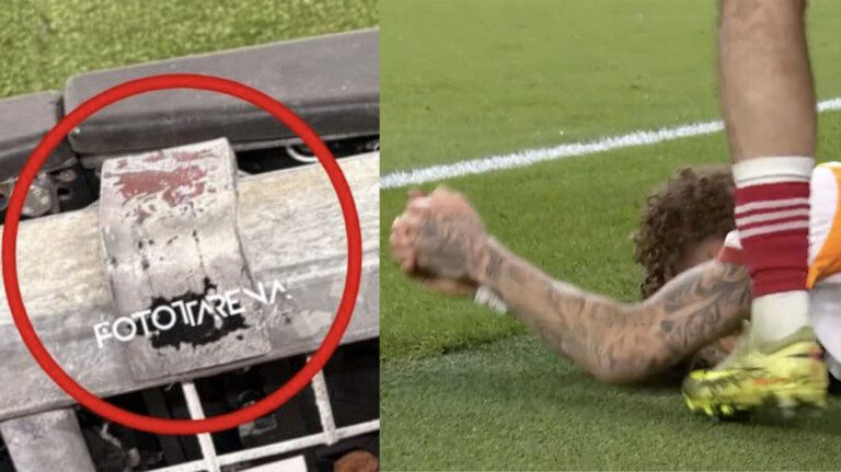 Champions Lang dito amputato